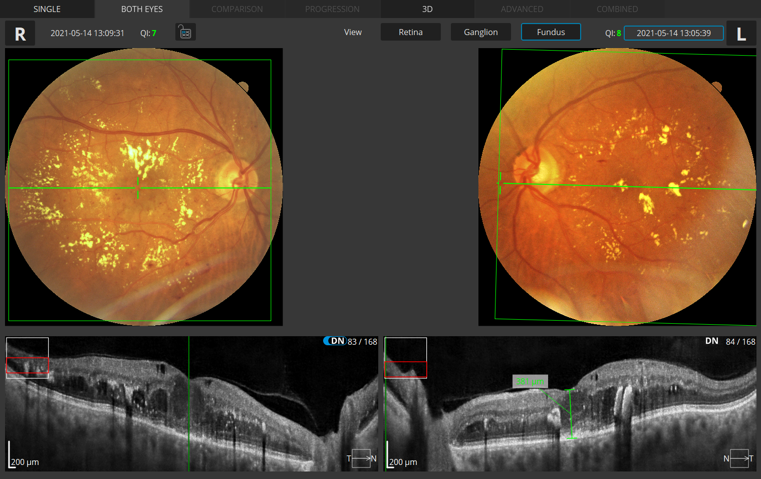 Retina 3D Both Eyes Fundus View