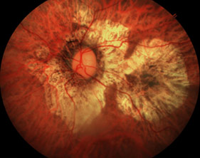 fundus retinal camera