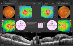 Retina 3D Both Eyes Retina View