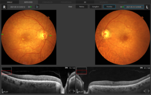 Retina 3D Both Eyes Fundus View