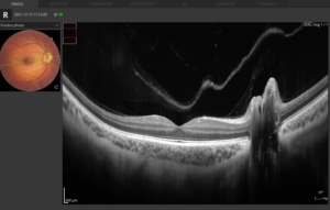 Retina B-scan Single View